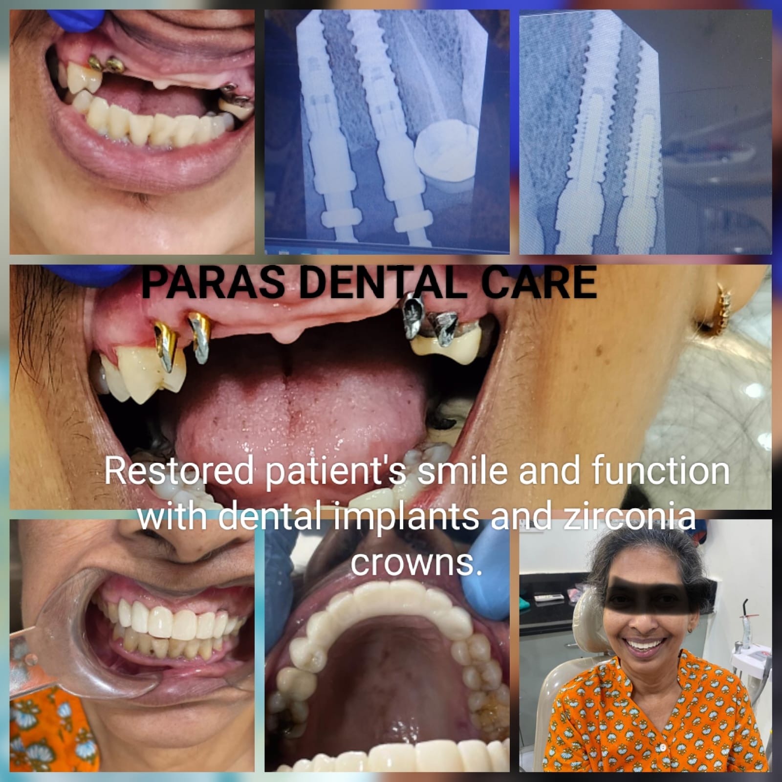 💥Dental Implants at Paras Dental Care: Your Pat... main image