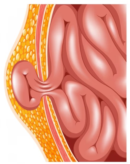 Hernia Surgery Hospital in Pune: Reliable and E... main image