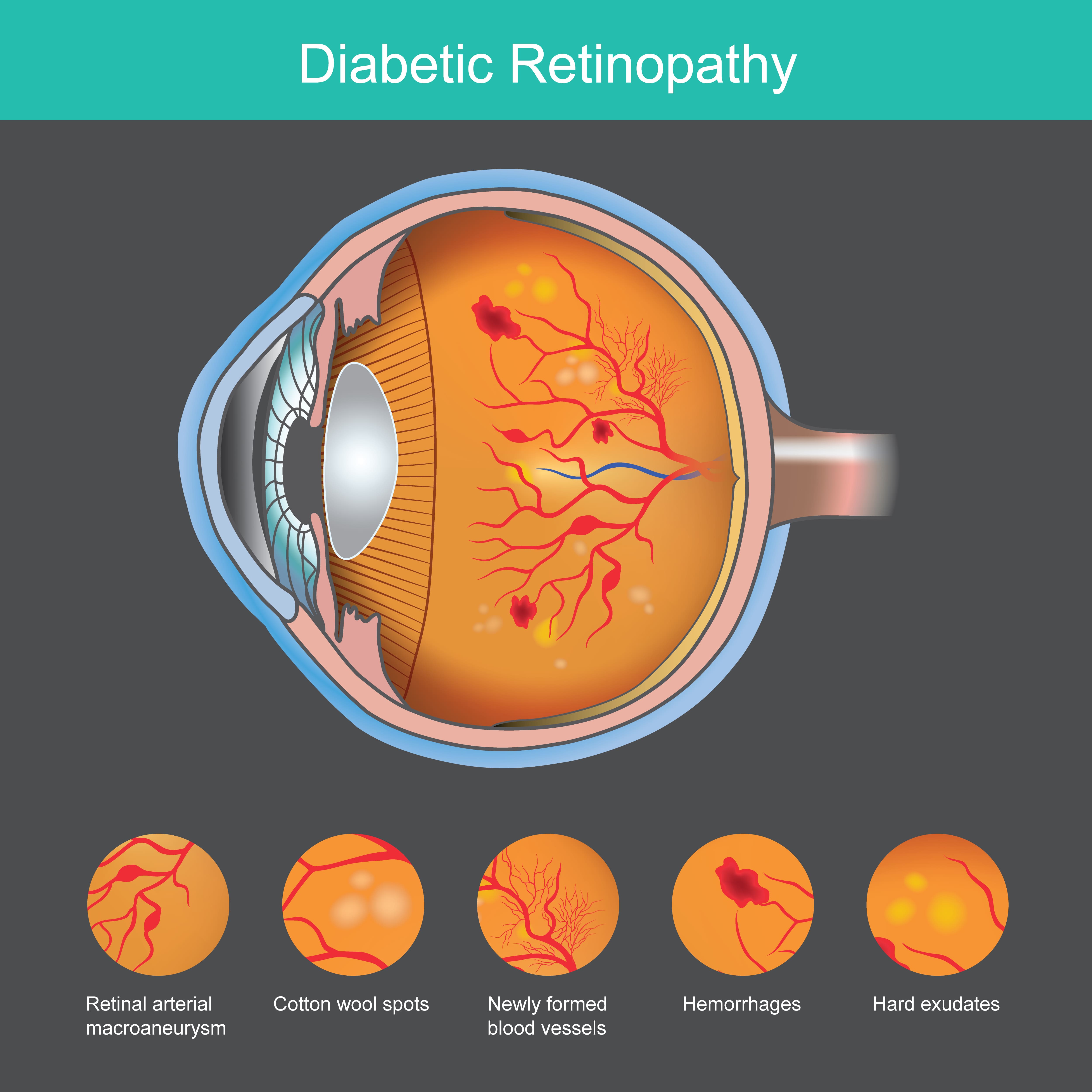 Diabetic Retinopathy Treatment in Bannerghatta Roa... main image