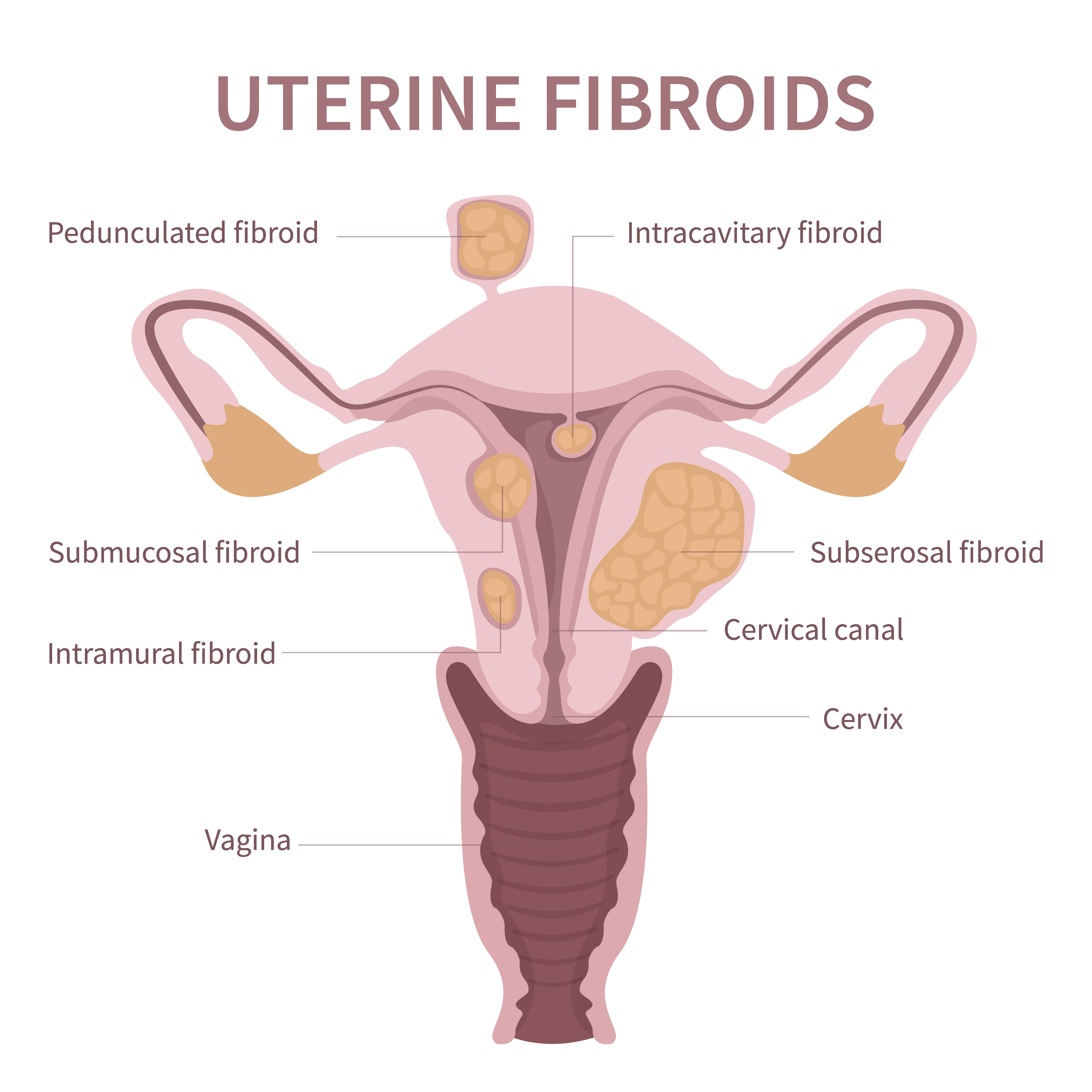 Managing Fibroid Uterus in Nagpur with Advanced Tr... main image