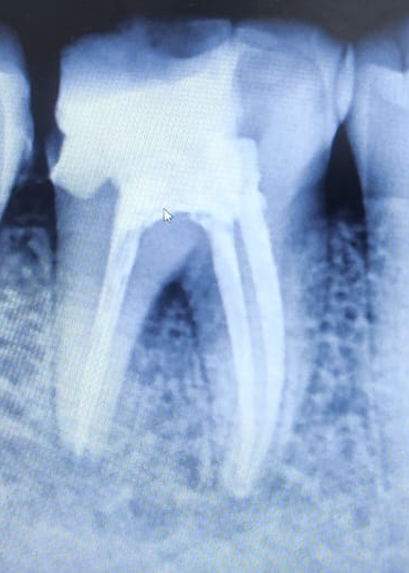root canal treatment done @dentofacialdental cl... main image