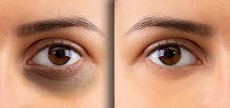 BEST DARK CIRCLES TREATMENT IN VADAPALANI @ELORA C... main image