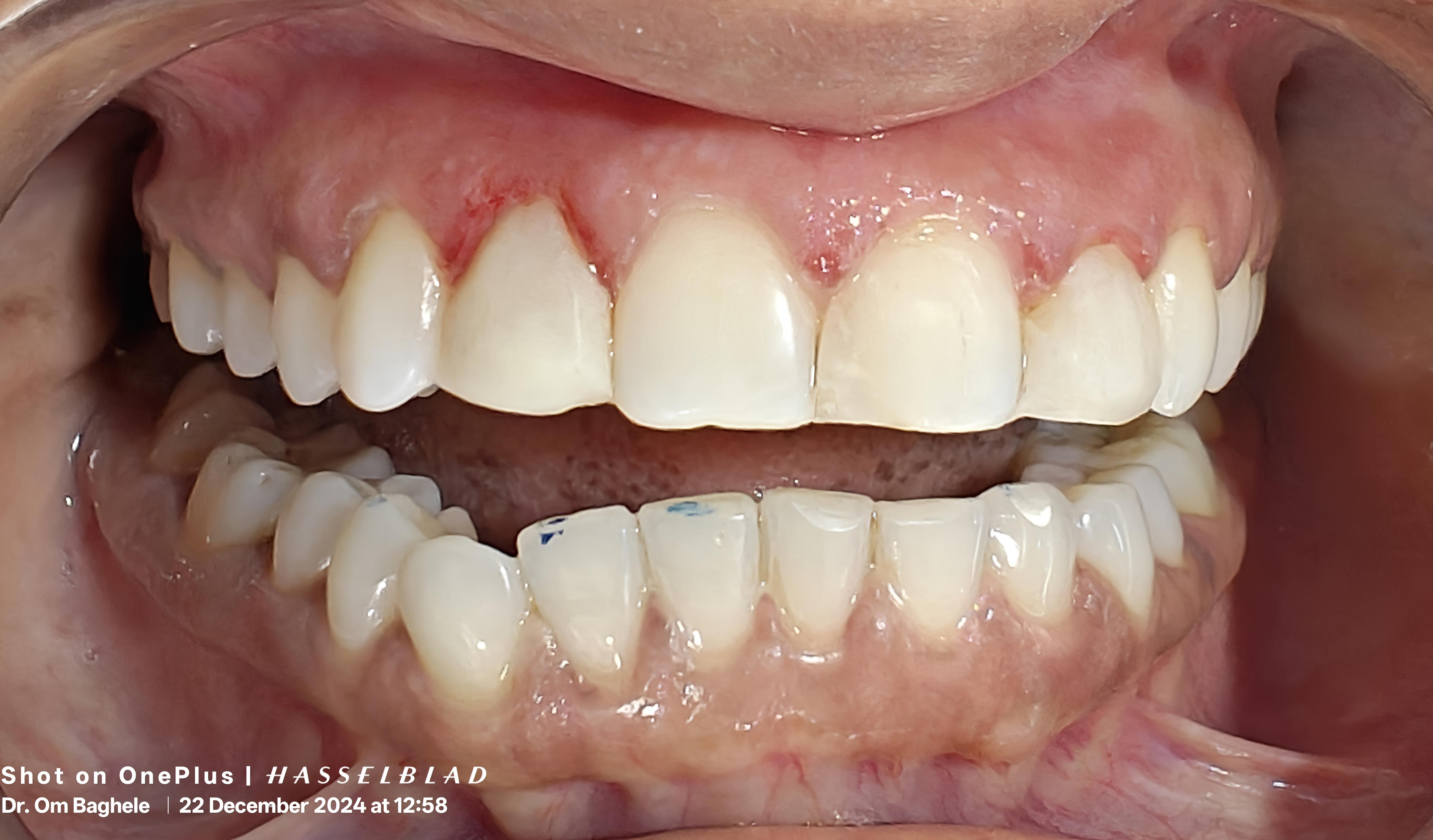 Tooth colored restorations 
The least invasive ... main image