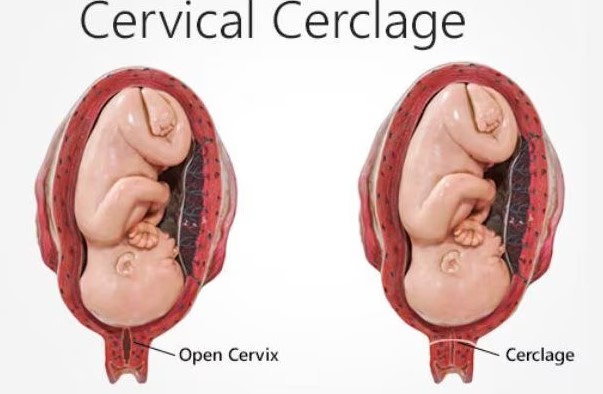 Cervical Cerclage Treatment in Nagpur: Supporting ... main image