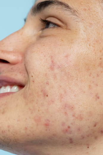 Acne and Acne Scars Treatment in R.A Puram Dealing... main image
