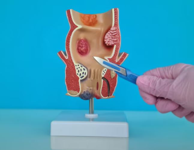 Fistula Treatment in Guindy: Specialized Care f... main image