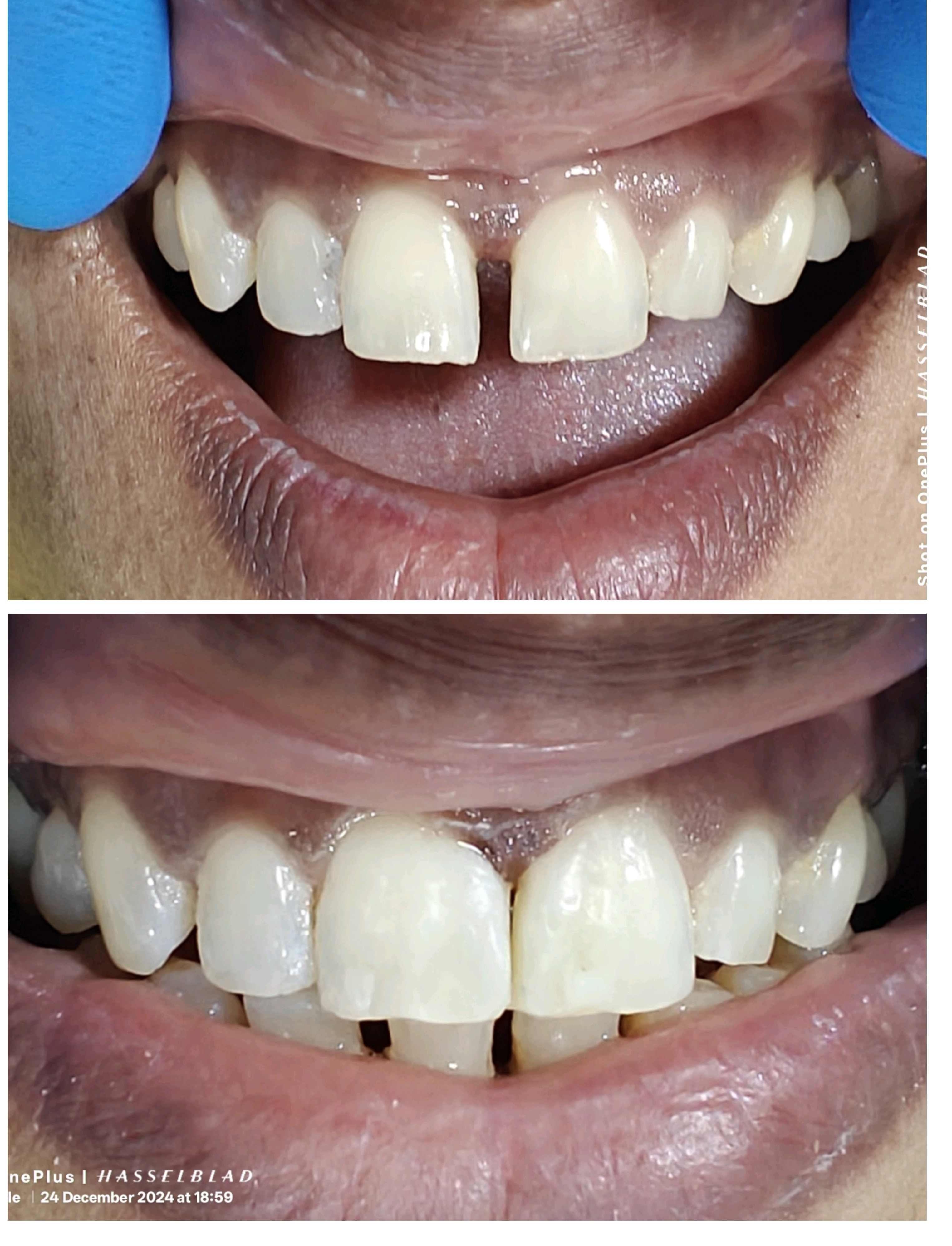 Diastema closure 
Gaps between the teeth may re... main image