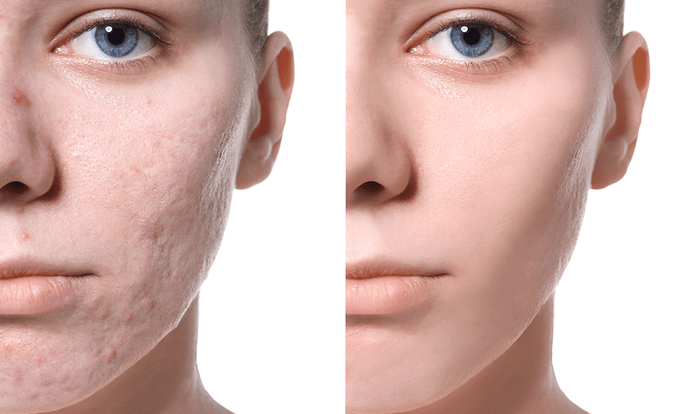 BEST ACNE SCAR TREATMENT IN VADAPALANI @ELORACL... main image