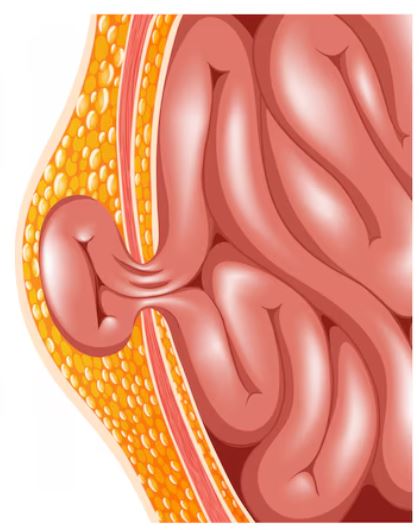 Hernia Clinic in Guindy: Advanced Hernia Treatm... main image