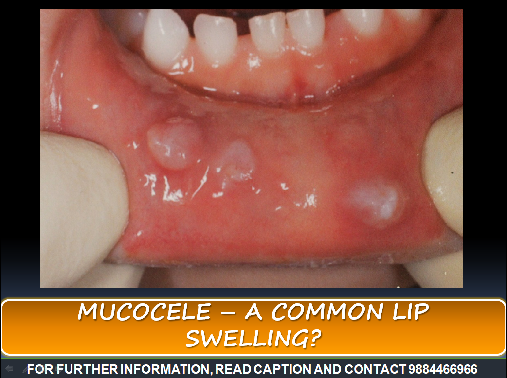 Mucous Cyst Lip Pop