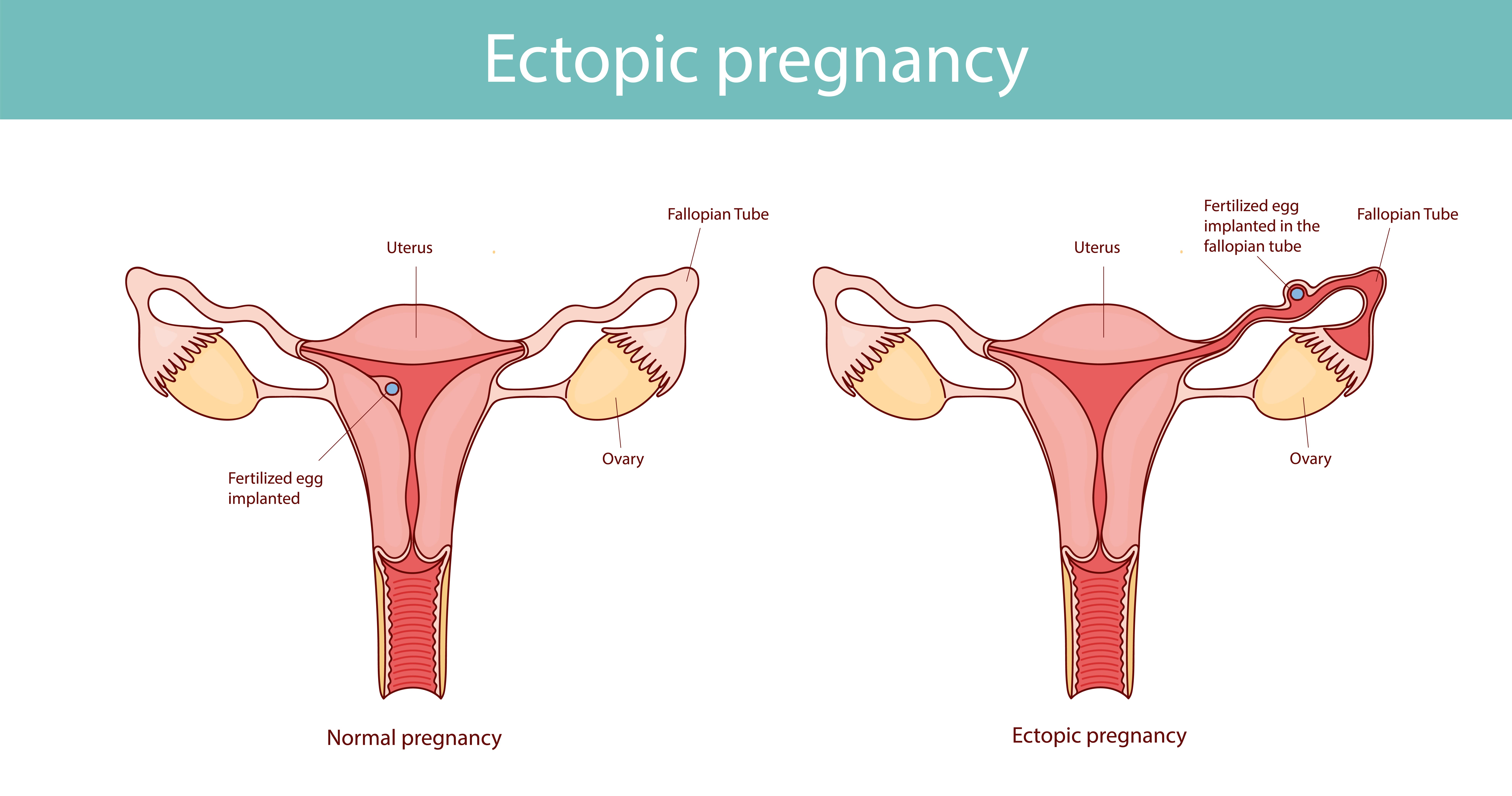 Ectopic Pregnancy in Nagpur: Prompt and Compassion... main image