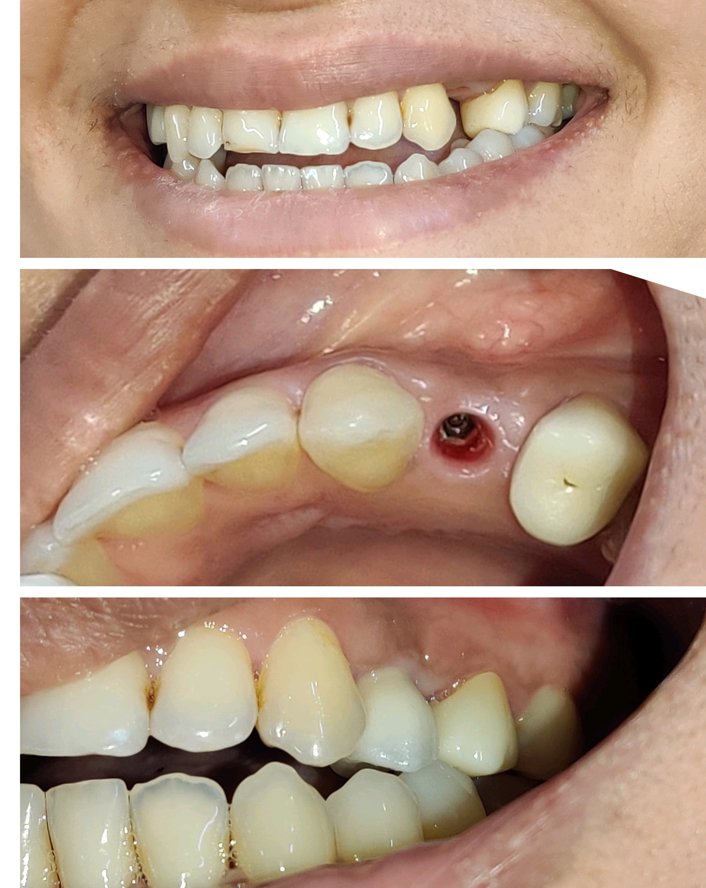 Never let a missing tooth hold you back from sm... main image