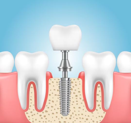 Implant Services in Nagpur Restore your missing te... main image