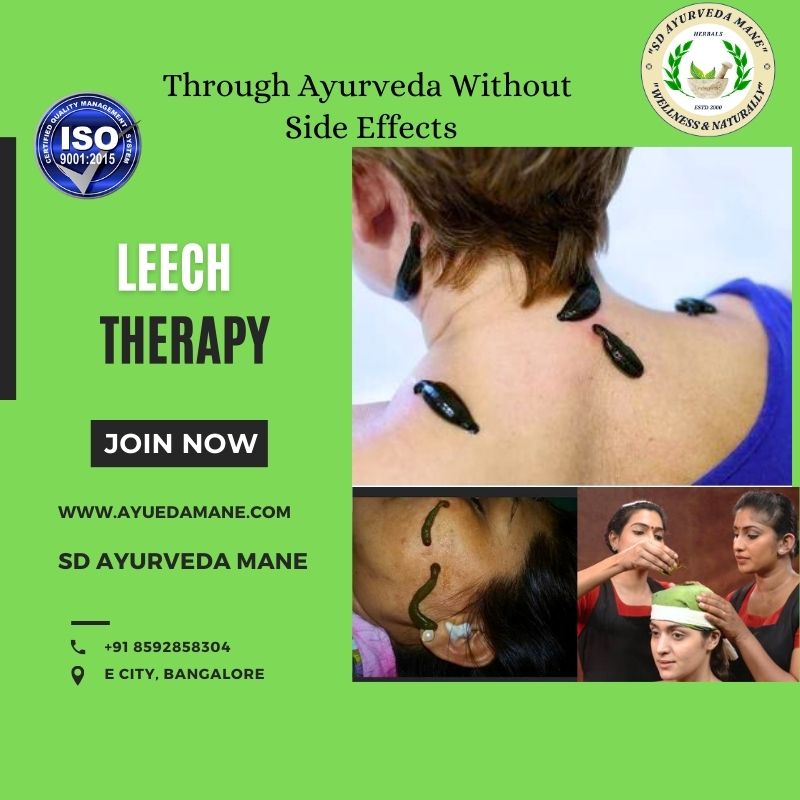 Leech Therapy at SD Ayurveda Mane – A Time-Tested ... main image