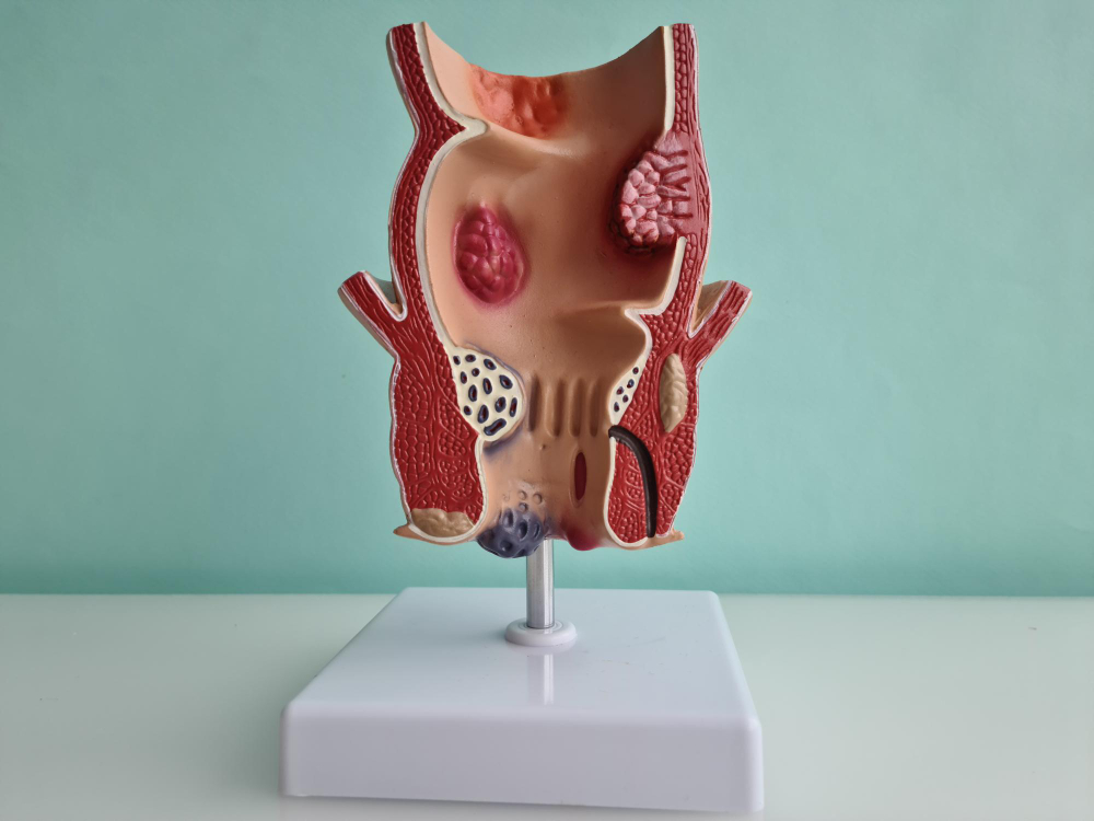 Fistula Clinic in Velachery: Specialised Treatm... main image