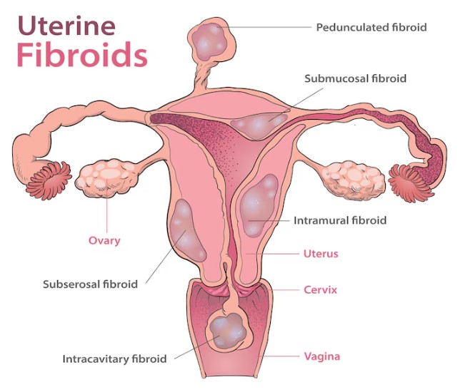 Fibroid Uterus Treatment Options in Nagpur Dealing... main image