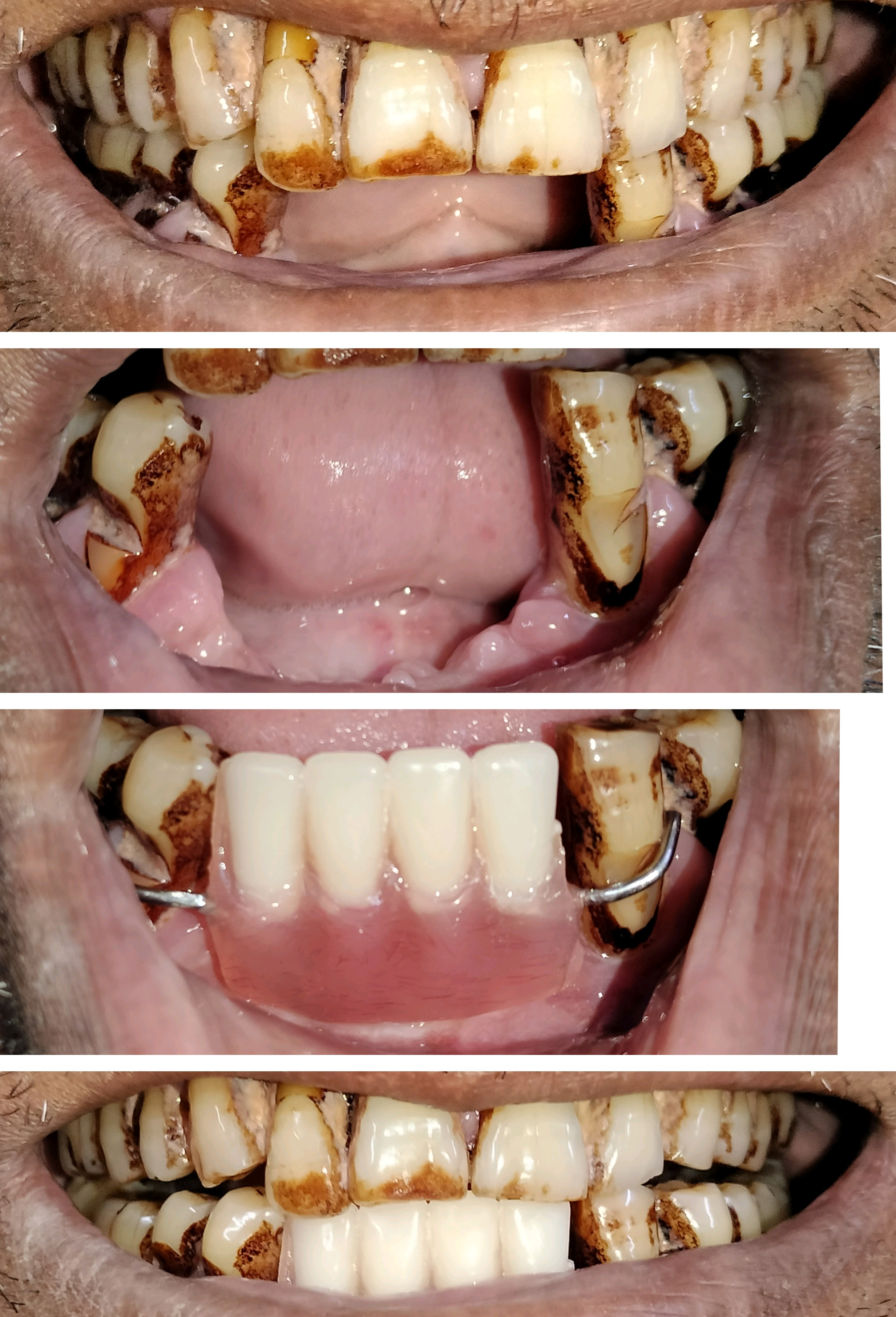 Removable partial dentures replace missing teet... main image