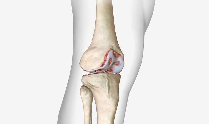 Knee Replacement Hospital in Pune: Advanced Care f... main image