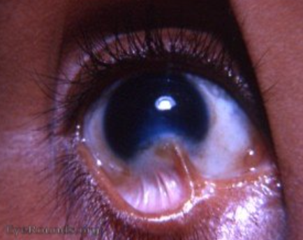 Symblepharon: Treating Eyelid Adhesions with Ca... main image