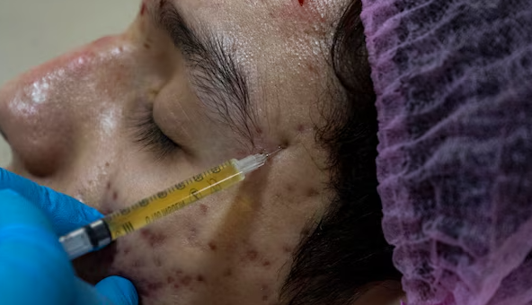 Acne and Acne Scars Treatment in MRC Nagar for Cle... main image