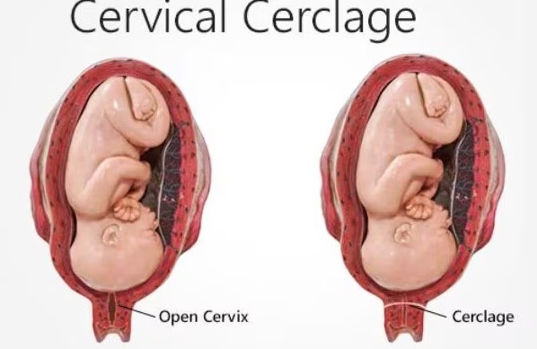 Cervical Cerclage in Nagpur: Ensuring a Safe Pr... main image