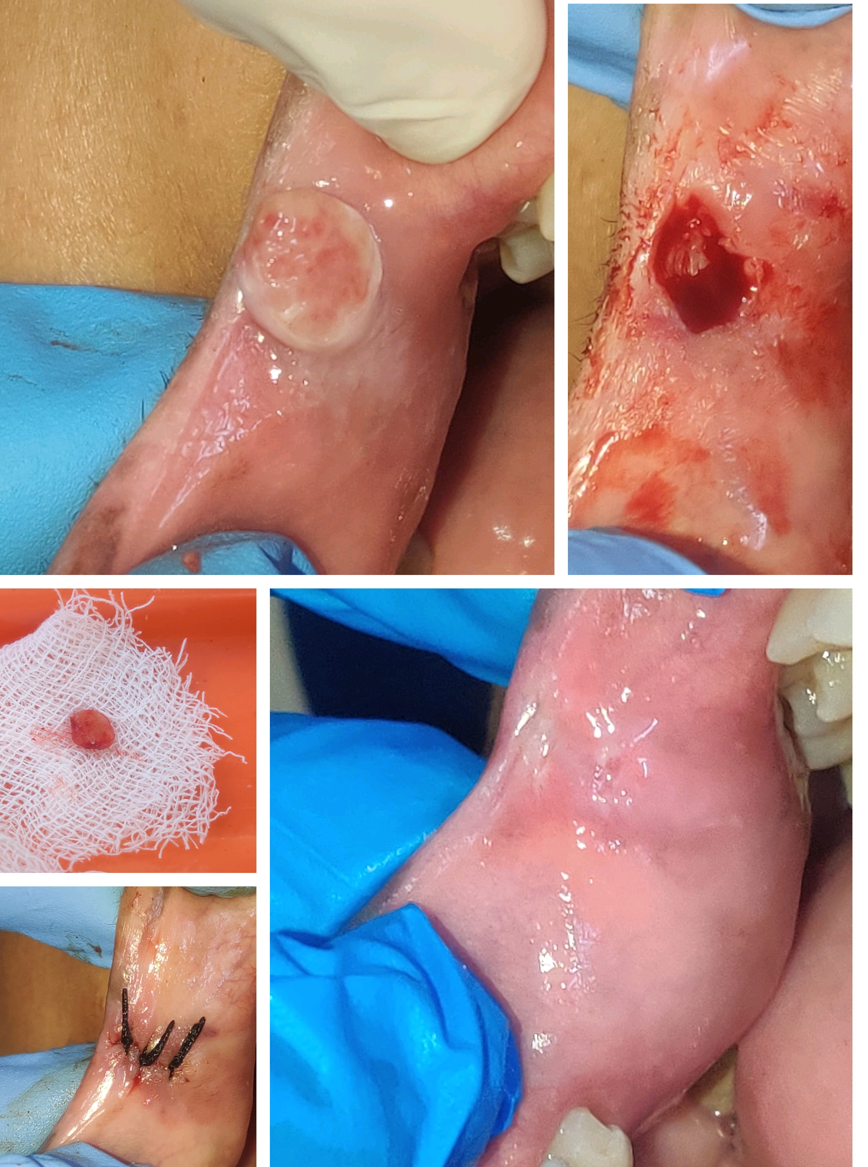 Treatment of suspicious lesions via Surgical Re... main image