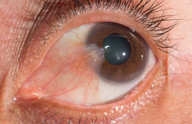 Pterygium: How to Treat and Prevent this Common Ey... main image