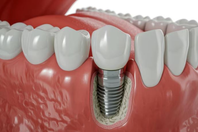 Implants Services in Nagpur for a Lasting Solution... main image