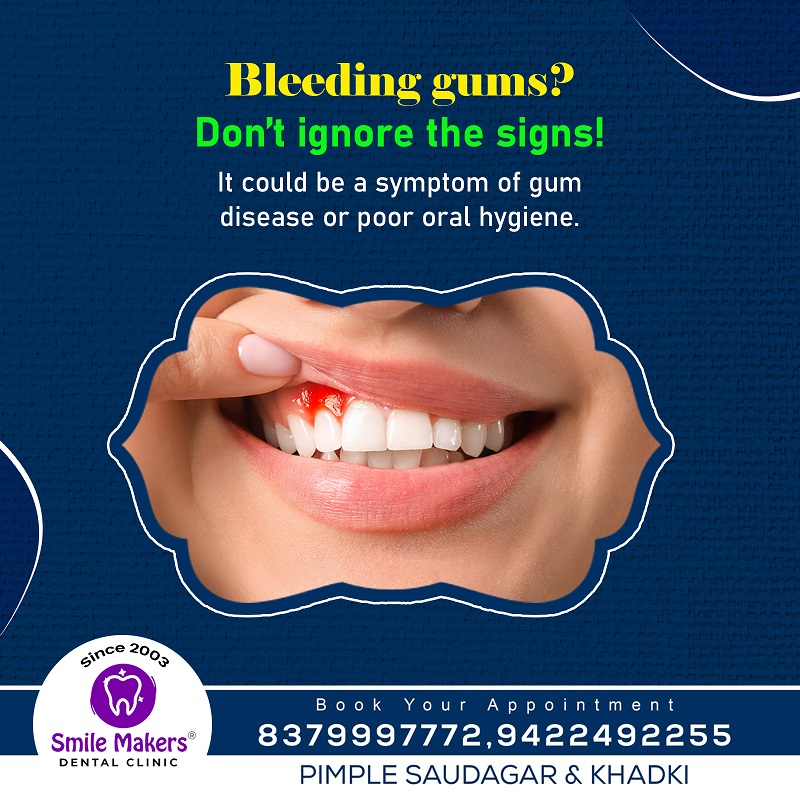 Best Dentist in Pimple Saudagar !

Bleeding Gum... main image
