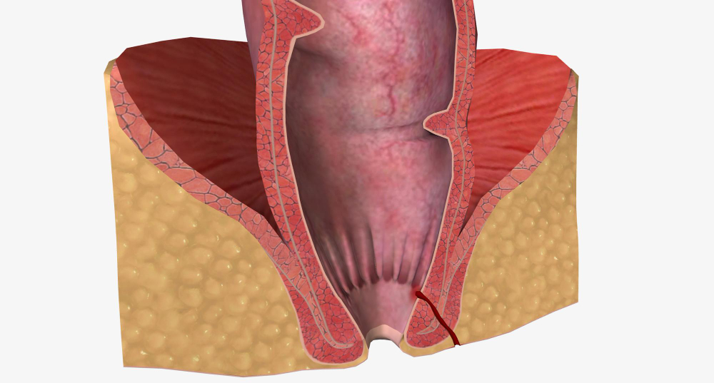 Advanced Haemorrhoids and Piles Treatment in Chenn... main image