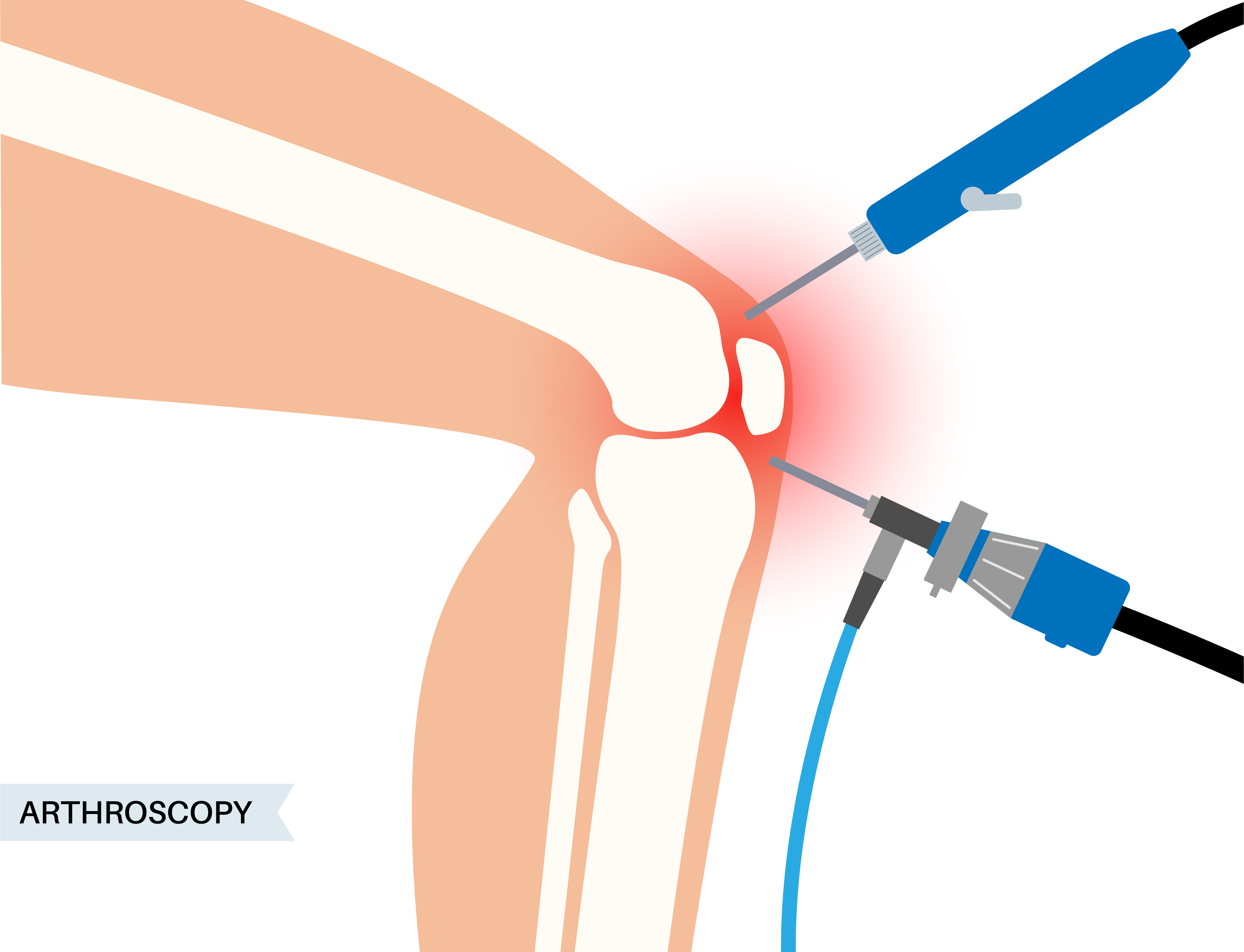 Best Arthroscopy Treatment in Chennai Arthroscopy ... main image