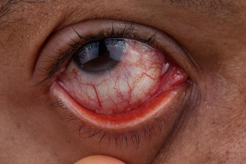 Dacryocystitis: Understanding and Treating Tear Du... main image