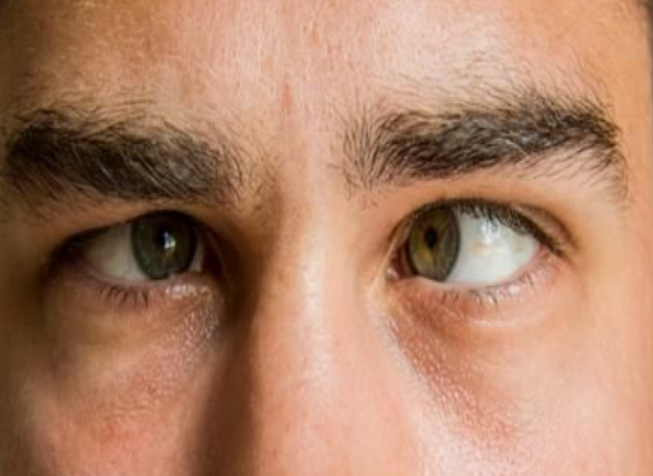 Squint: Treatment Options for Misaligned Eyes S... main image