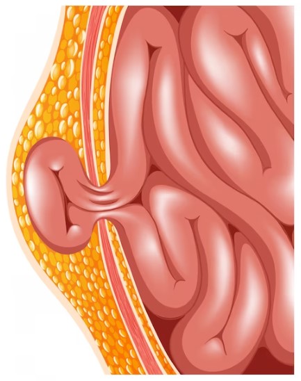 Hernia Surgery Hospital in Pune: Effective Treatme... main image