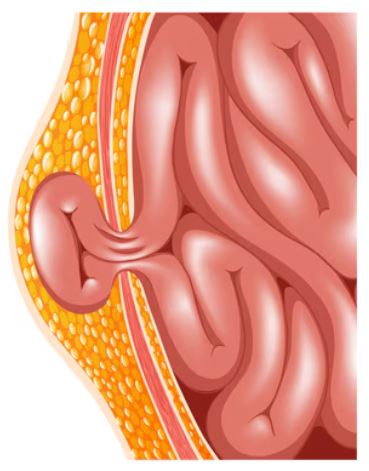 Hernia Clinic in Guindy: Trusted Care for Effec... main image
