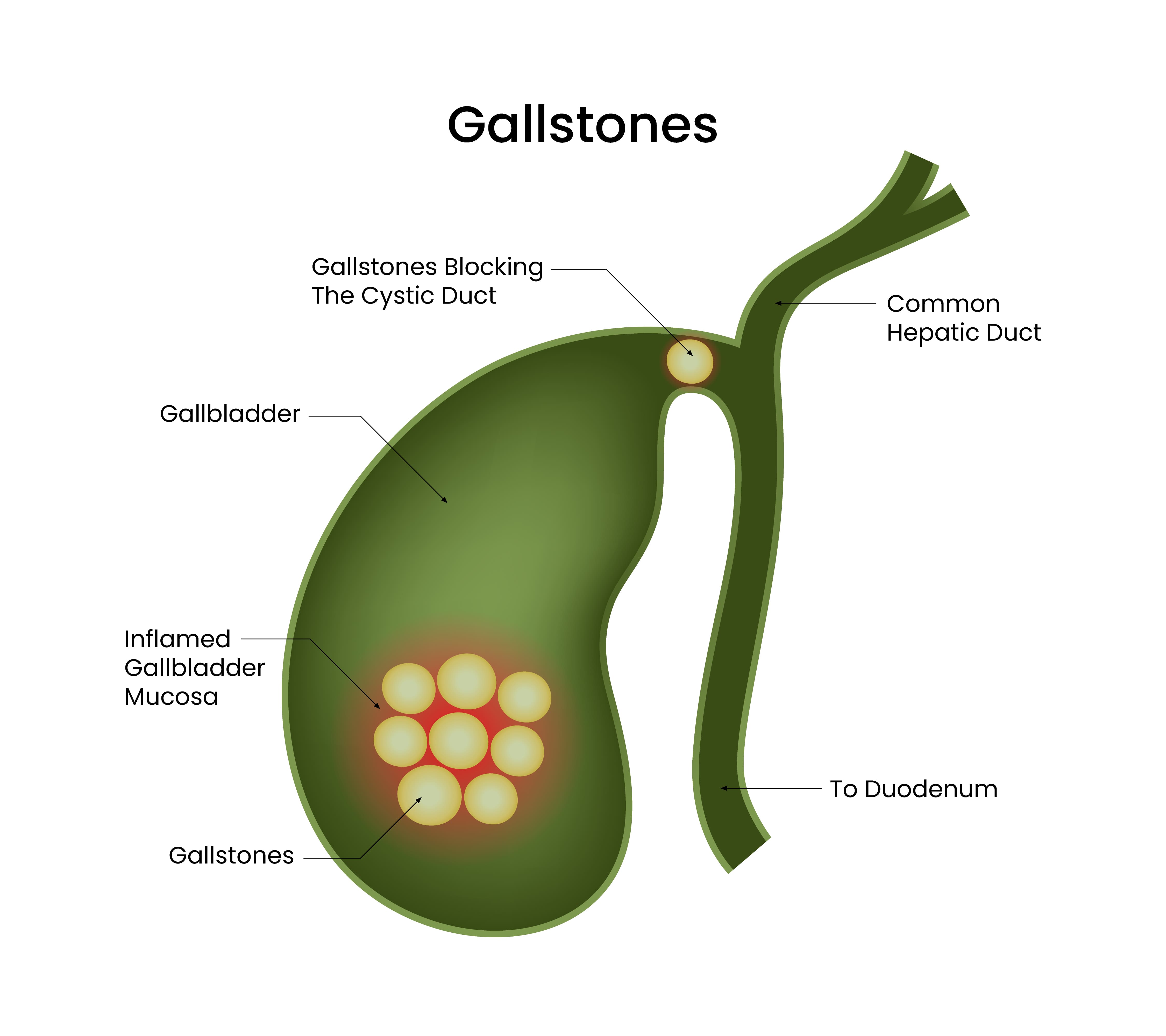 Best Gallbladder/Gallstone Treatment Hospital i... main image