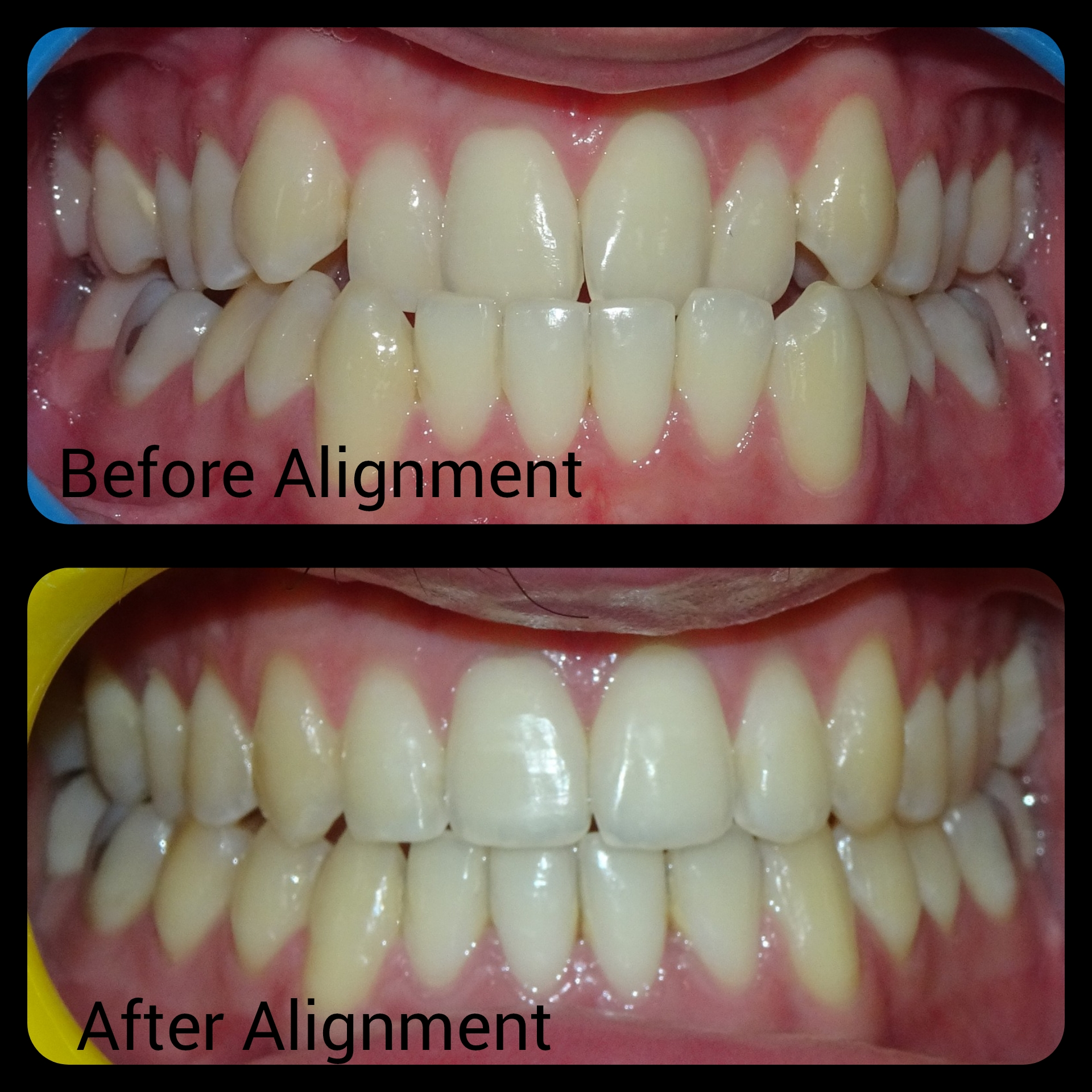 Well aligned teeth do not jury improve your SMI... main image