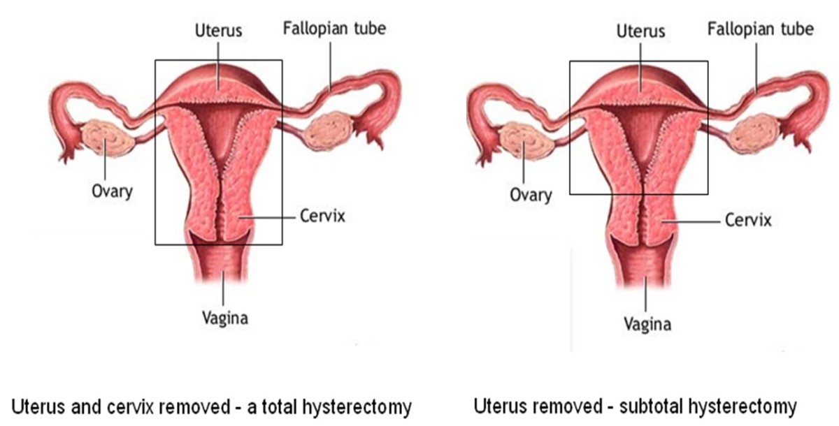 Hysterectomy Procedures in Nagpur A hysterectom... main image