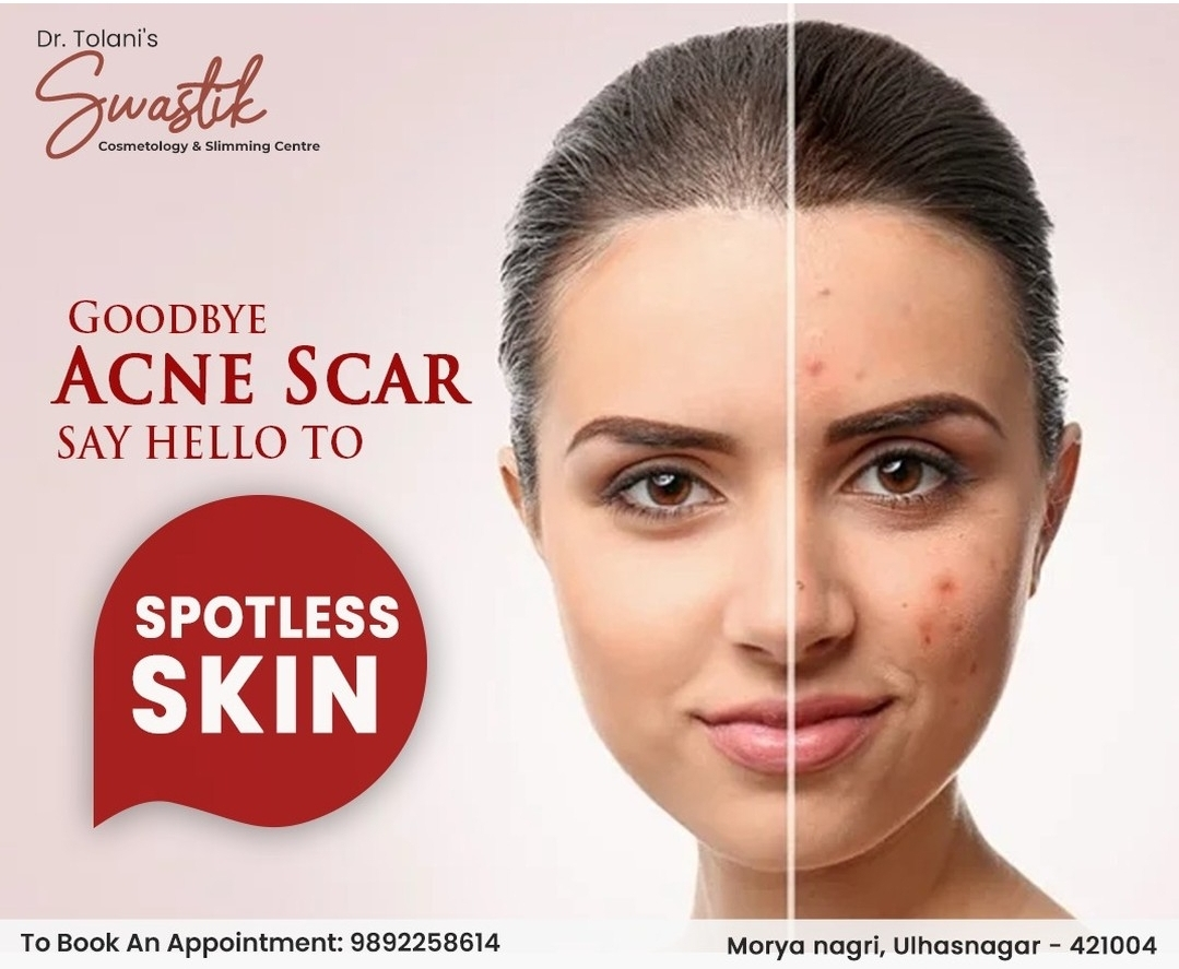  Dealing with acne scars? Swastik Cosmetology And ... main image