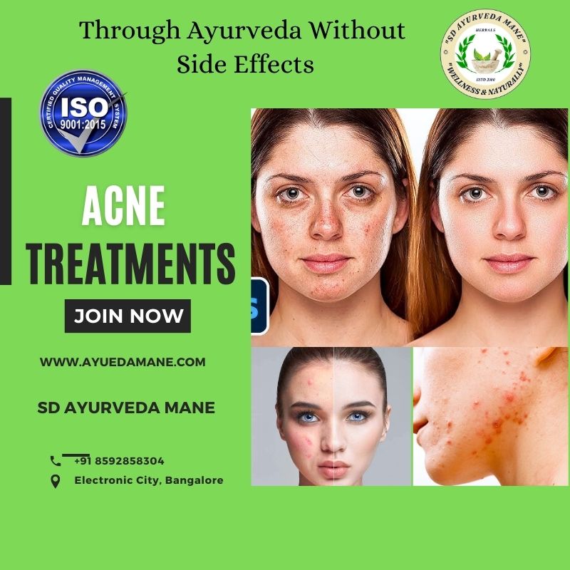 Ayurvedic Acne Treatment at SD Ayurveda Mane – Hol... main image