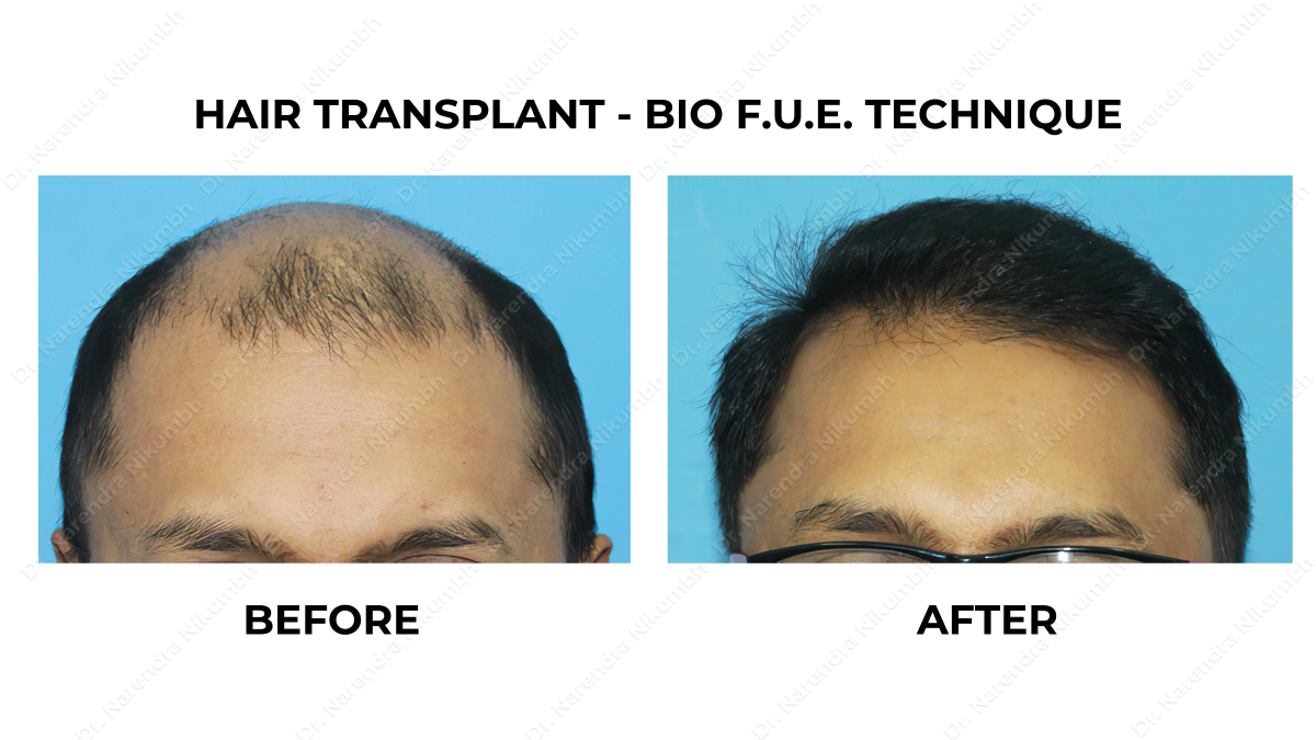 Best Hair Transplant In Thane Hair Transplant C... main image