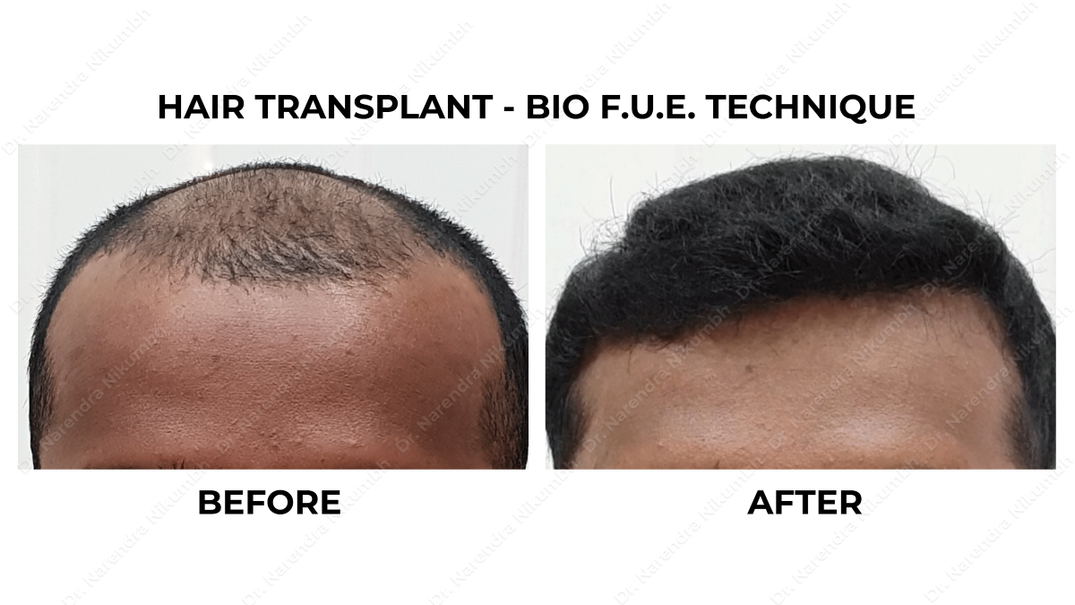 Hair Transplant Surgery in Thane Hair Transplan... main image