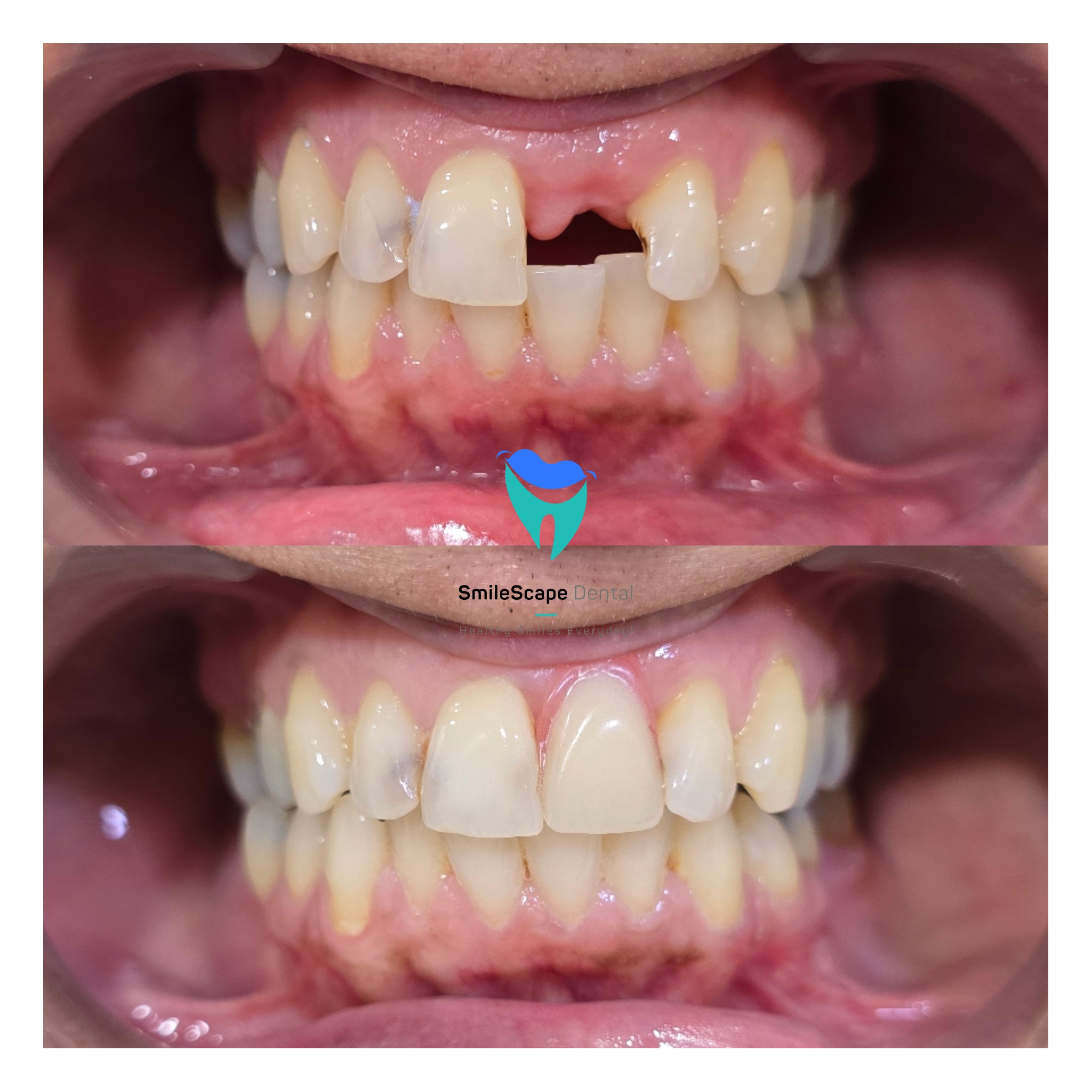 Each and every tooth in the mouth plays an impo... main image