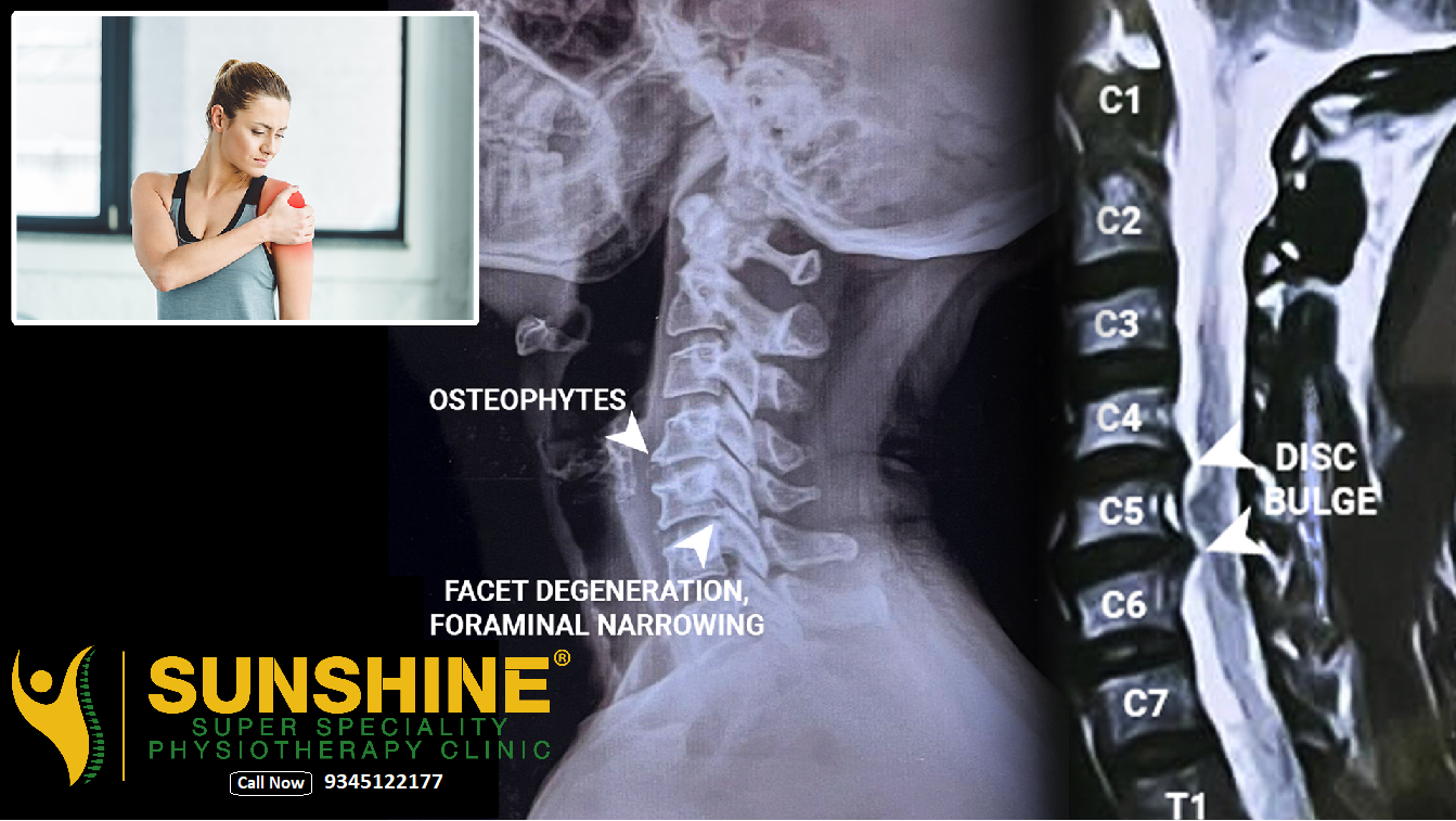 Cervical Disc Bulge with Foraminal Narrowing
A ce... main image