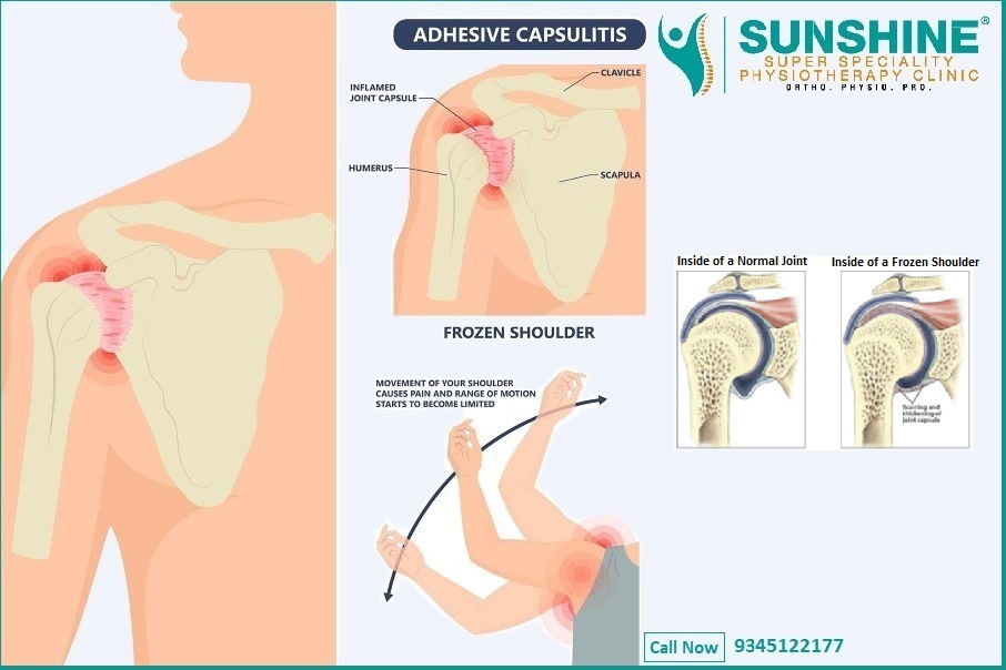 Adhesive Capsulitis (Frozen Shoulder) and Physi... main image