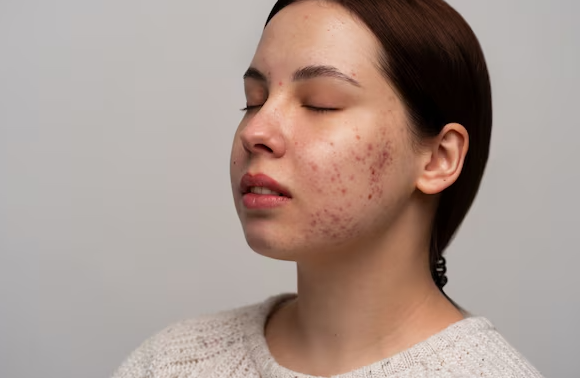 Acne Treatment in MRC Nagar for Clearer Skin Strug... main image