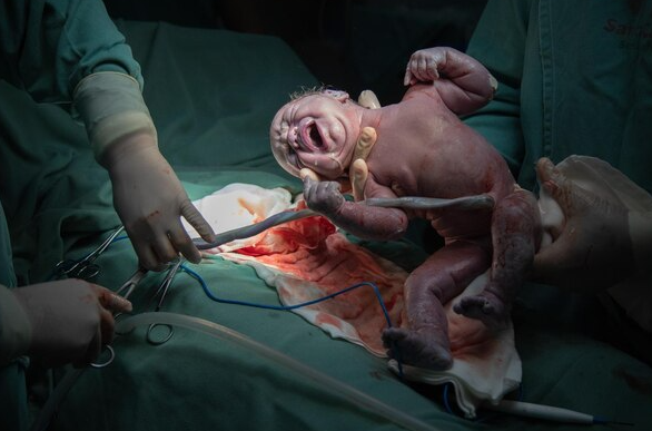 Safe and Advanced Caesarean Section Procedures ... main image
