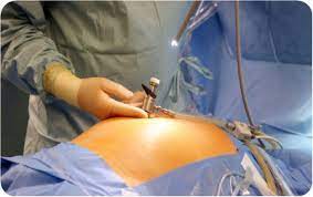 Advanced Gynaecological Surgeries in Nagpur At Gre... main image