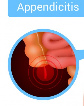 Laparoscopic Procedures for Appendicitis in Che... main image