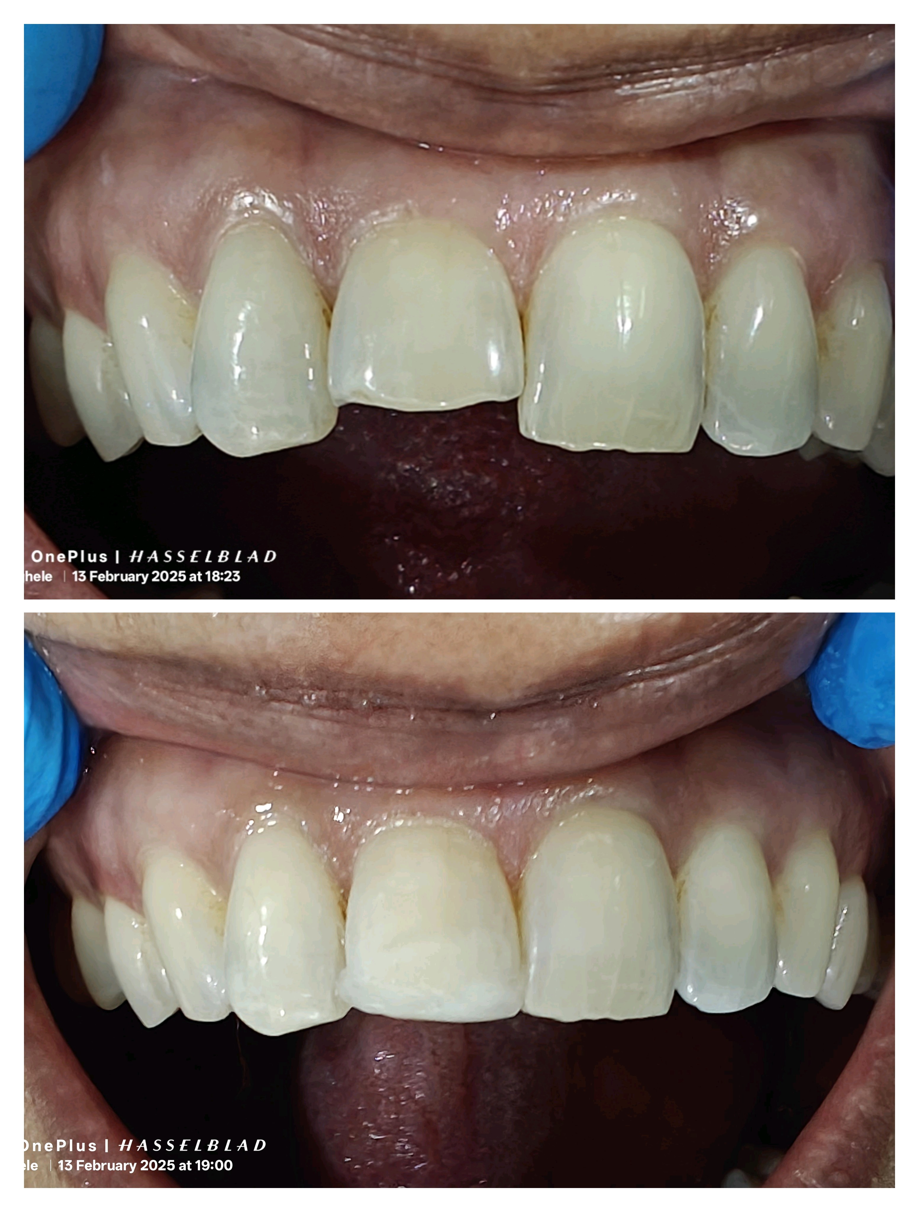 Short teeth smile makeover 
Uneven length of th... main image
